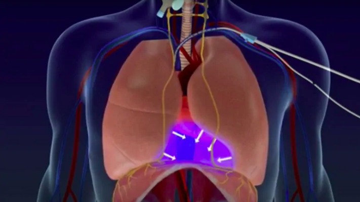 LungPacer Device from Bio Conscious Technologies