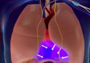 LungPacer Device from Bio Conscious Technologies